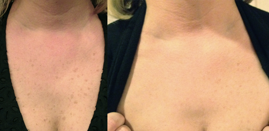 IM_Lumecca_515_9jShortPulsed_KB