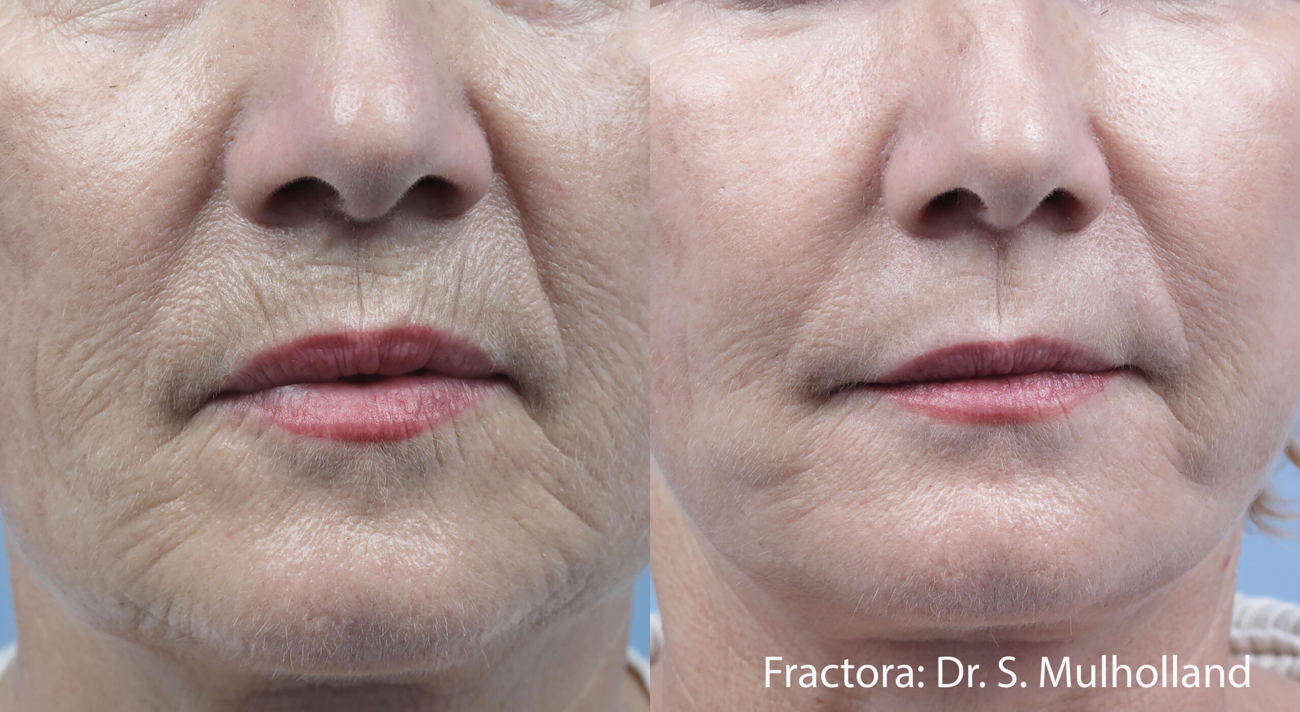 SM_Fractora_2b_1tx_60to62mj